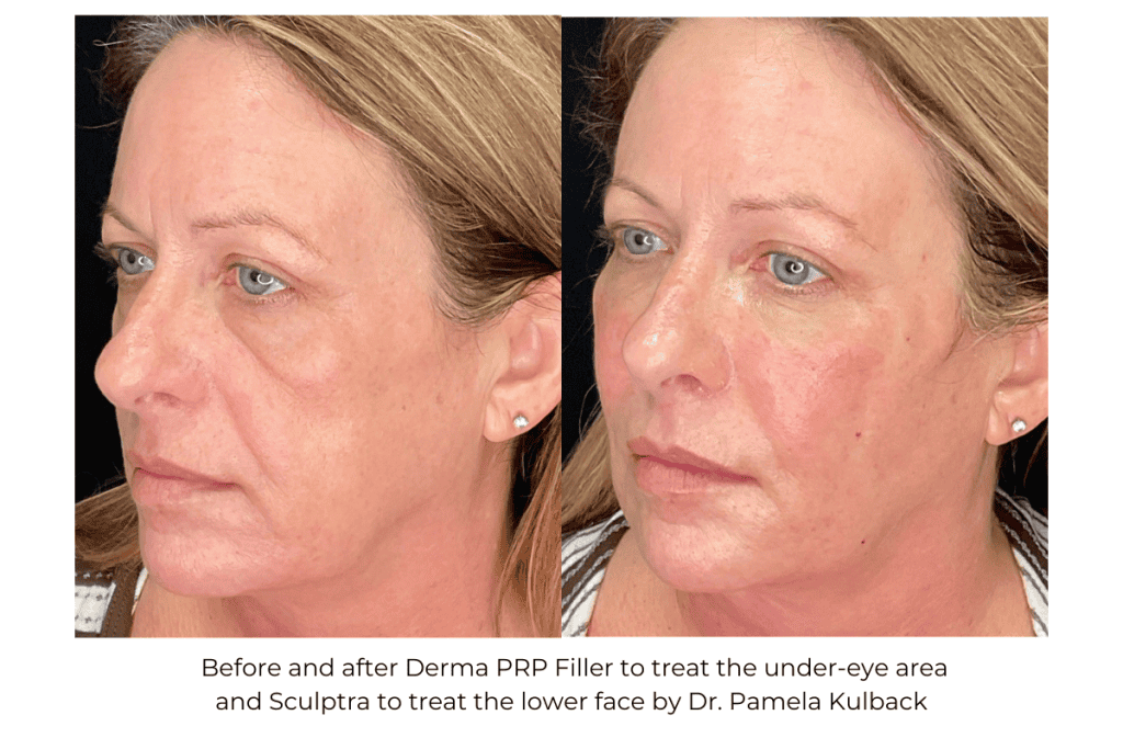Before and after Derma PRP Filler under-eye area and sculptra to the lower face by Dr. Pamela Kulback