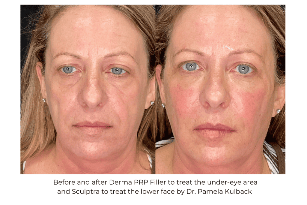 Before and after Derma PRP Filler under-eye area and sculptra to the lower face by Dr. Pamela Kulback in Trusville AL