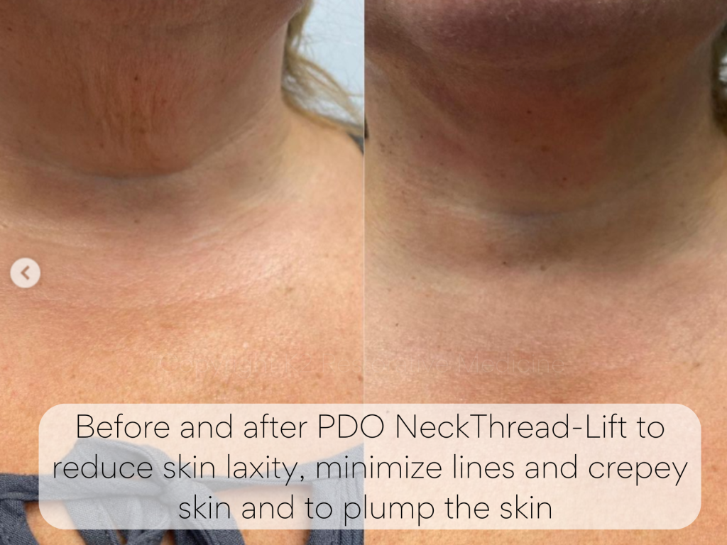 Before and after PDO NeckThread-Lift to reduce skin laxity, minimize lines and crepey skin and to plump the skin