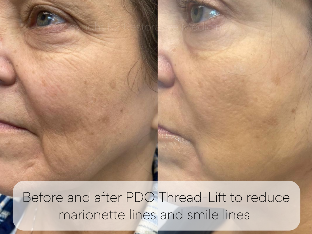 Before and after PDO Thread-Lift to reduce marionette lines and smile lines By Dr, Pamela Kulback in Trussville AL