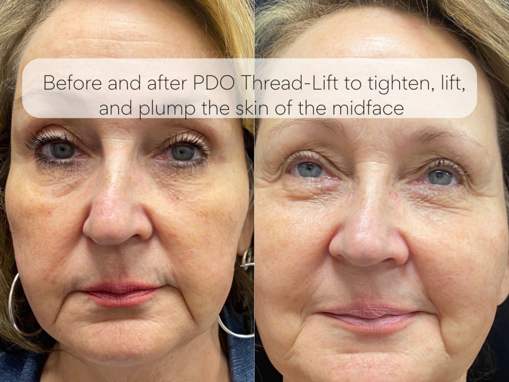 Before and after PDO Thread-Lift to tighten, lift, and plump the skin of the midface