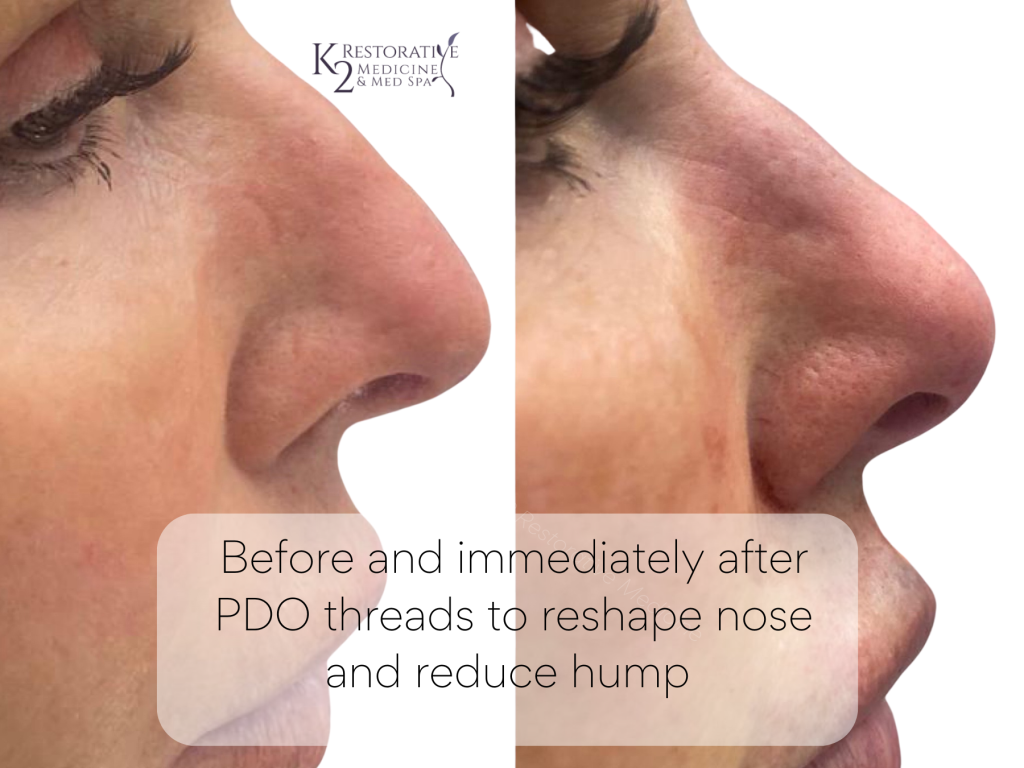 Before and immediately after PDO threads to minimize hump and turn tip of nose up by Dr. Pamela Kulback