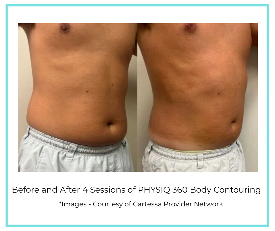 Before and After 4 Sessions of PHYSIQ 360 Body Contouring