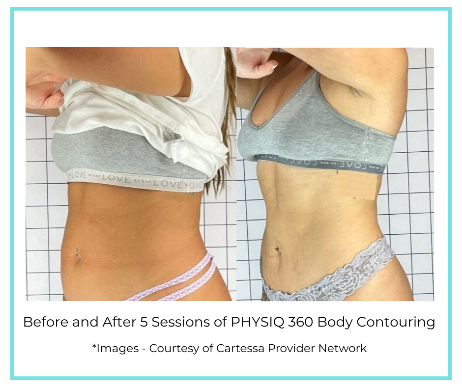 Before and After 5 Sessions of PHYSIQ 360 Body Contouring