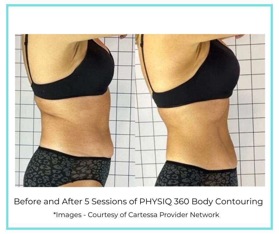Before and After 5 Sessions of PHYSIQ 360 Body Contouring