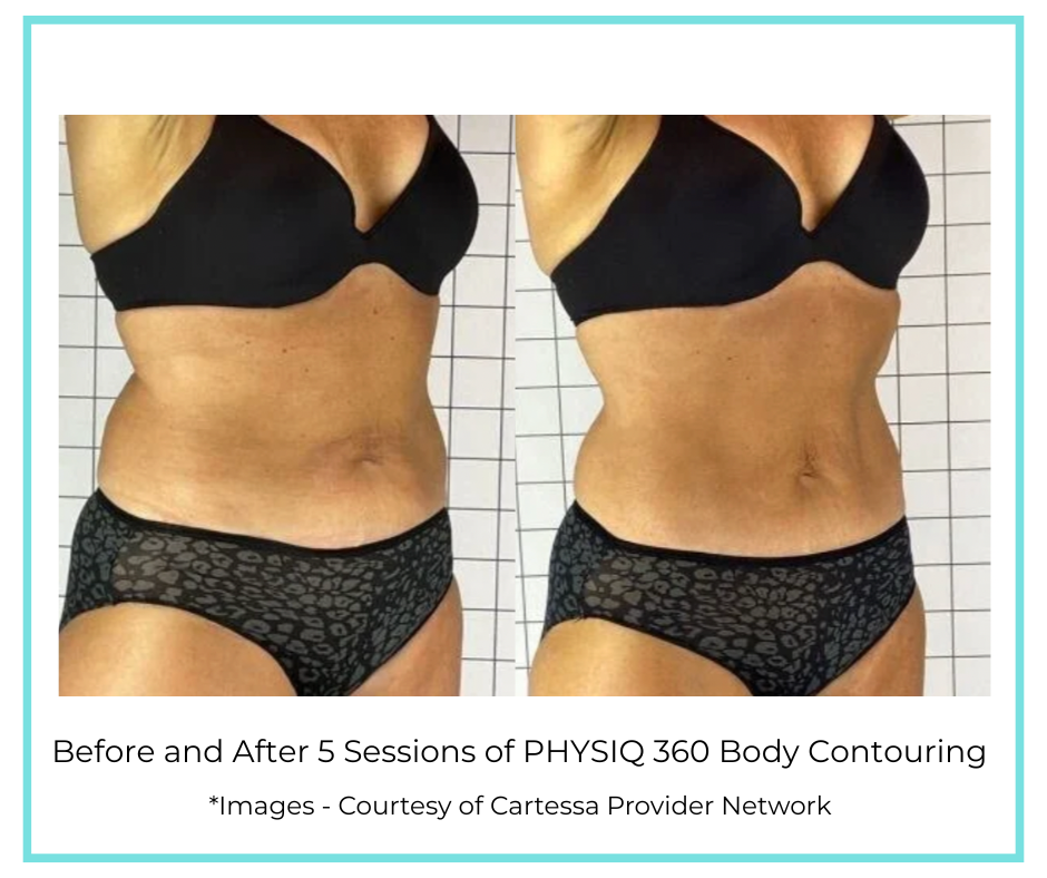 Before and After 5 Sessions of PHYSIQ 360 Body Contouring (4)