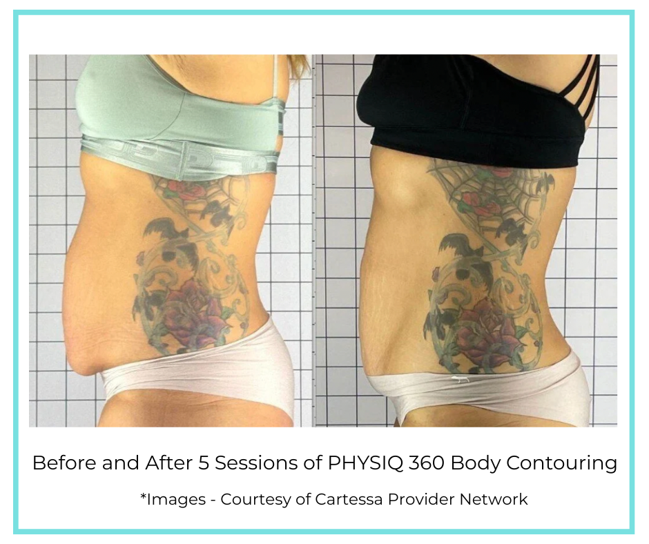 Before and After 5 Sessions of PHYSIQ 360 Body Contouring