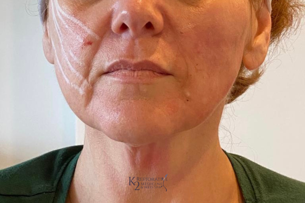 PDO thread at K2 Restorative Medicine and Med Spa Trussville, AL