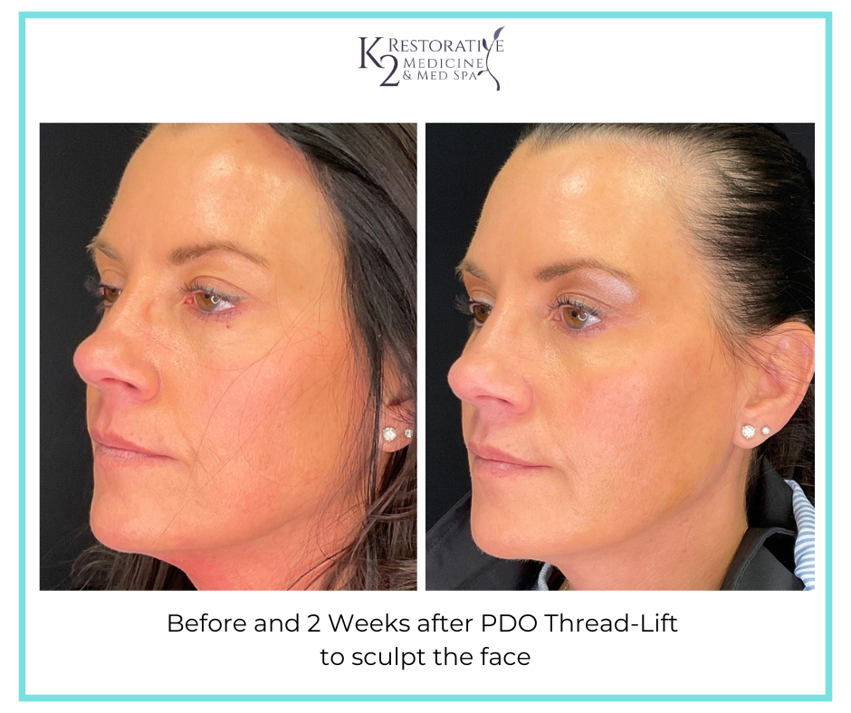Before and 2 Weeks after PDO Thread-Lift to sculpt the face