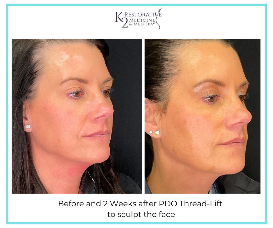 Before and 2 Weeks after PDO Thread-Lift to sculpt the face