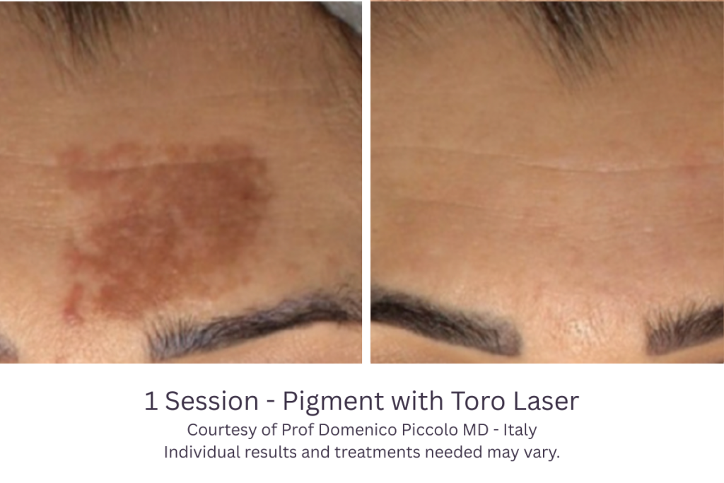 1 Session - Pigment with Toro Laser