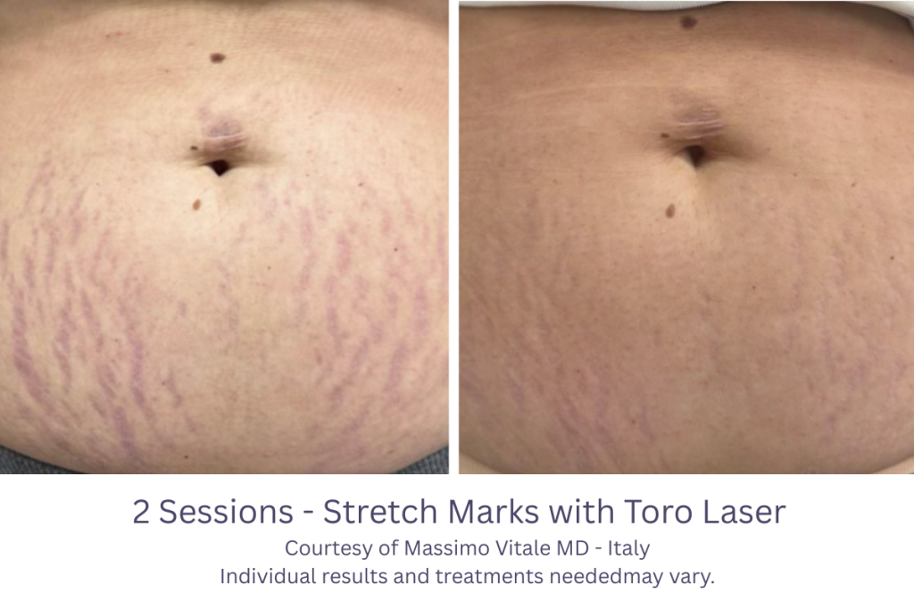 2 Sessions - Stretch Marks with Toro Laser in Trussville, AL