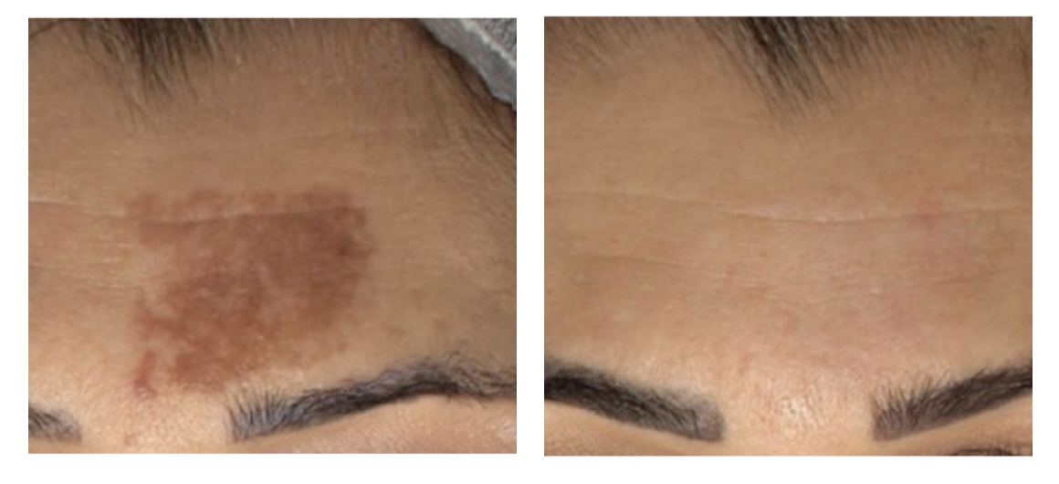 1 Session - Pigment | Courtesy of Prof Domenico Piccolo MD - Italy Individual results and treatments needed may vary.
