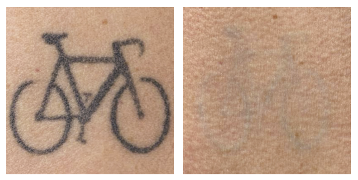 3 Sessions - Tattoo Removal | Courtesy of Massimo Vitale MD - Italy Individual results and treatments needed may vary.
