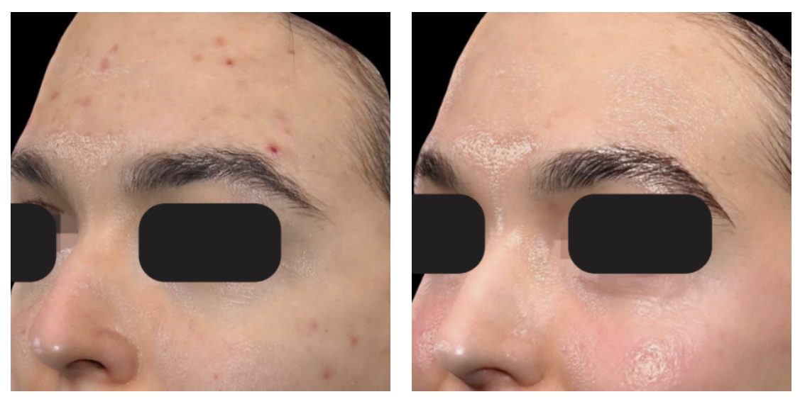 1 Session - Detox Carbon Peel & Fractional Revitalization | Courtesy of Massimo Vitale MD - Italy Individual results and treatments needed may vary.