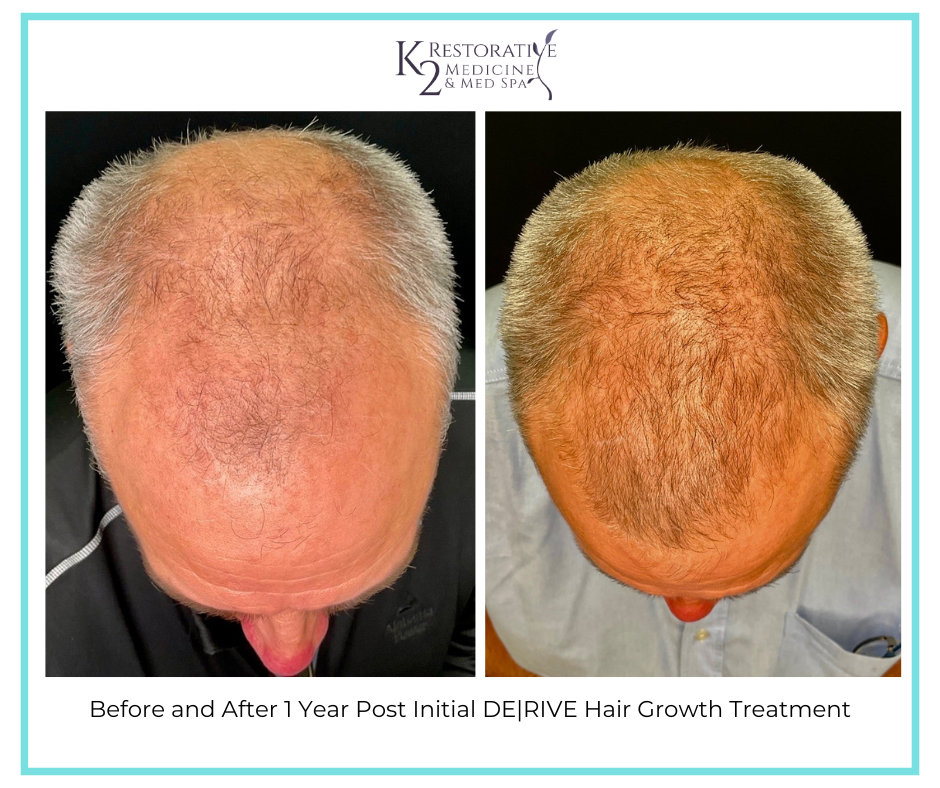Before and After 1 Year Post Initial DERIVE Hair Growth Treatment