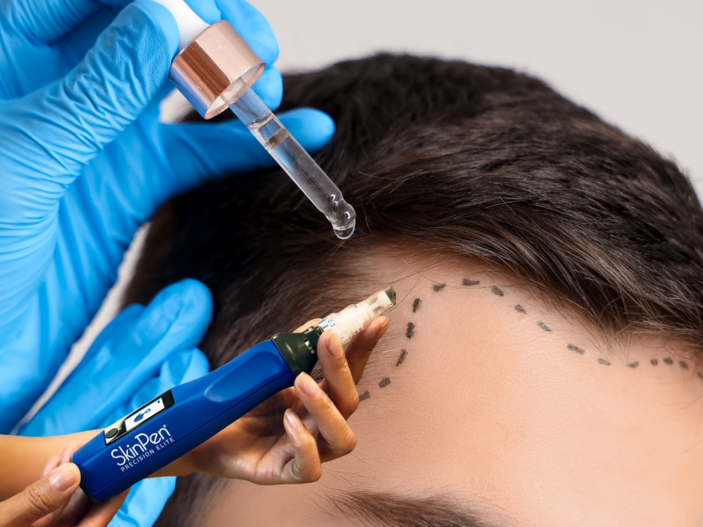 SkinPen microneedling for hair loss at k2 Restorative Medicine an Med Spa