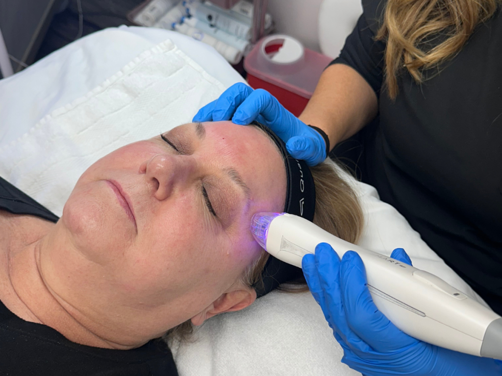 Virtue RF Microneedling with Jackie at K2 Restorative Medicine and Med Spa