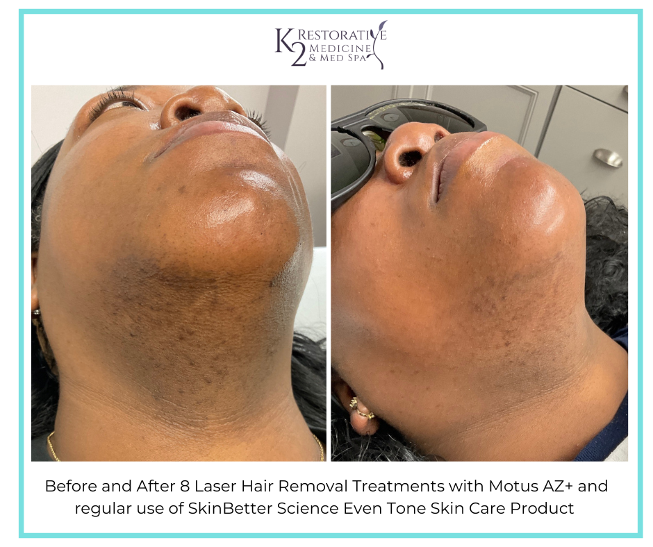 Before and After 8 Laser Hair Removal treatments + SkinBetter Science Even Tone Product