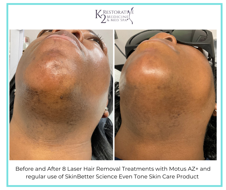 Before and After 8 Laser Hair Removal treatments + SkinBetter Science Even Tone Product