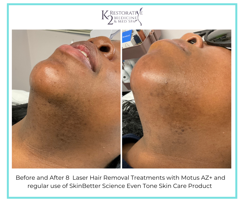 Before and After 8 Laser Hair Removal treatments + SkinBetter Science Even Tone Product