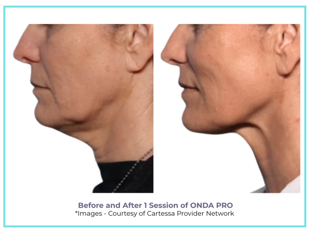 BEFORE AND AFTER ONDA PRO NECK TREATMENT