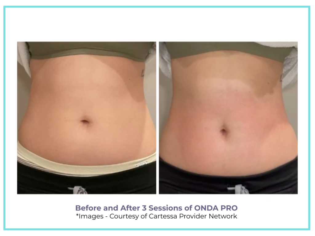 BEFORE AND AFTER ONDA PRO for belly fat