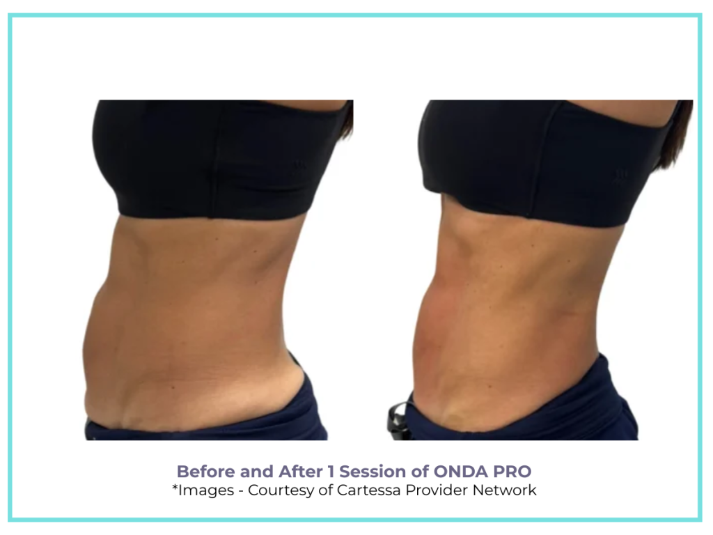 ONDA PRO ABDOMEN TREATMENT FOR FAT REDUCTION