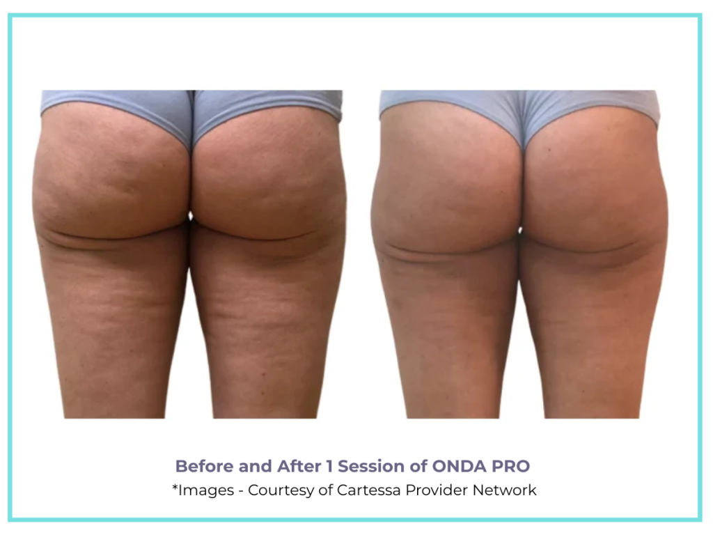 ONDA PRO TREATMENT FOR CELLULITE ON THE BUTTOCKS