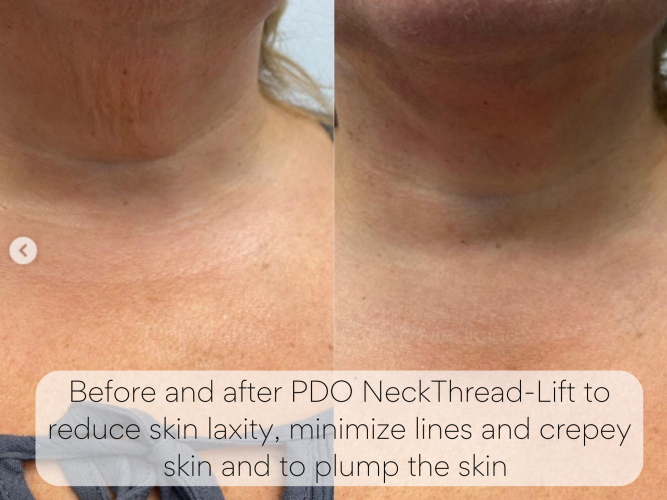 Before and after PDO NeckThread-Lift to reduce skin laxity, minimize lines and crepey skin and to plump the skin