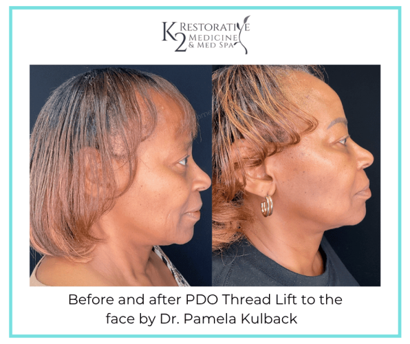 Before and after PDO Thread-Lift to the face by Dr. Pamela Kulback