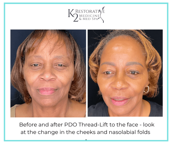 Before and after PDO Thread-Lift to the face - look at the change in the cheeks and nasolabial folds