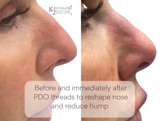 Before and immediately after PDO threads to minimize hump and turn tip of nose up by Dr. Pamela Kulback