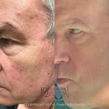 Before and after CoolPeel and IPL