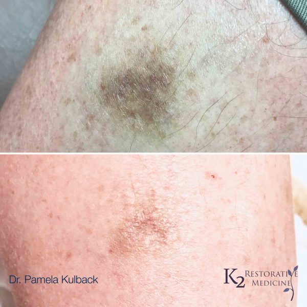 ipl-beforeandafter ipl-beforeandafter